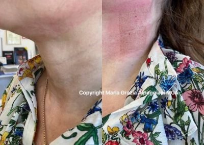 lifting sottomentoe e collo-min