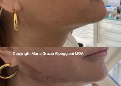 linea viso lifting -min