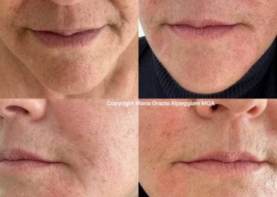 mesoterapia acido ialuronico