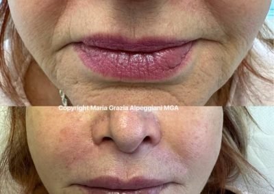 mesoterapia ialuronico