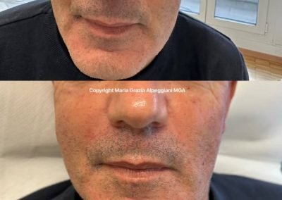 mesoterapia vitamine