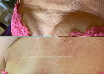 mesoterapia vitamine acido ialuronico