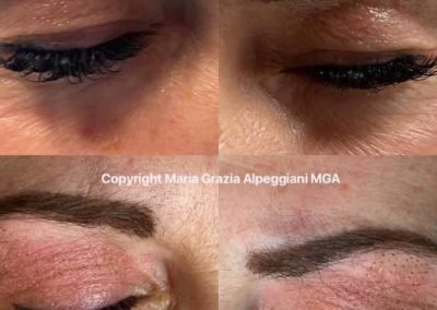 palsma pen occhi lifting palpebre-min