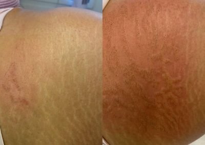 plasma pen elimina smagliatura glutei