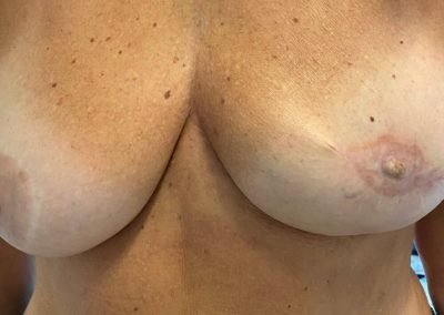 prima della ricostruzione seno