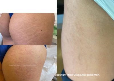 prima e dopo copertura smagliature glutei b