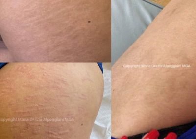 prima e dopo smagliature dermopigment