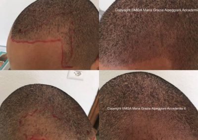 ricostruzione tempie 2