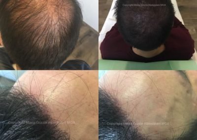 ricostruzione tempie e dendità