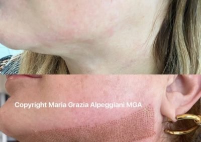 riduzione e lifting-min