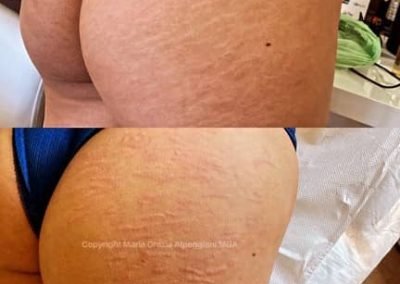 rimozione copertura smagliature glutei