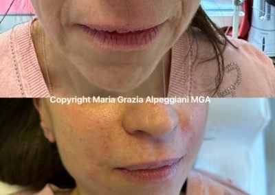 ringiovanimento acido ialuronico