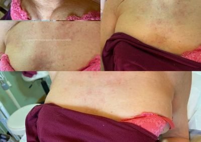 ringiovanimento acido ialuronico corpo