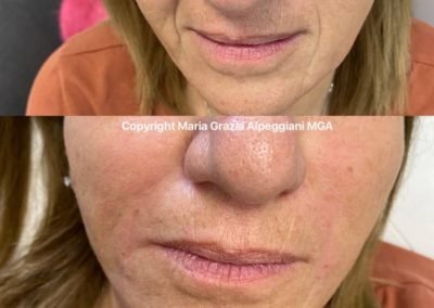 ringiovanimento viso