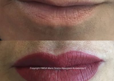 riposizionamento labbra con dermopigmentazione