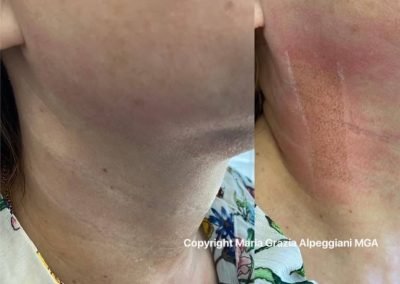 rughe collo e sottomento-min