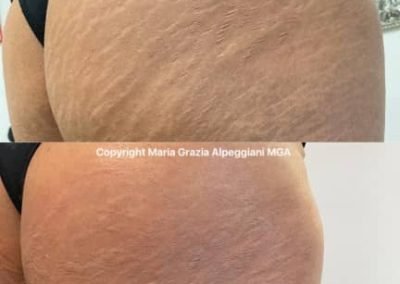 smagliature dermopigmentazione copertura