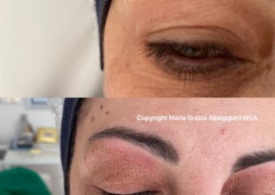 sollevamento palpebra lifting non chirurgico-min