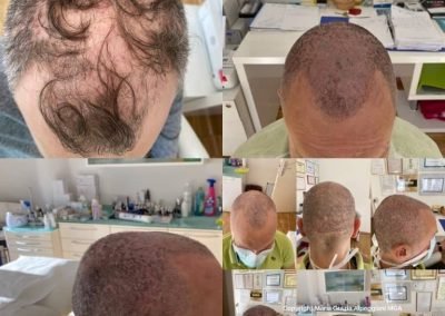 trico prima e dopo trattamento-min