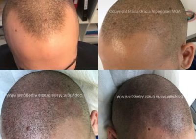 tricopigmentazione avanzamento tempie-min
