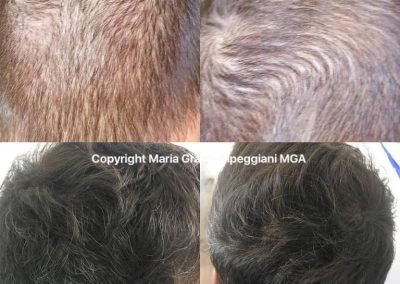tricopigmentazione biorivitalizzazione-min