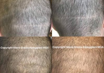 tricopigmentazione copertura cicatrice fut autotrapianto-min