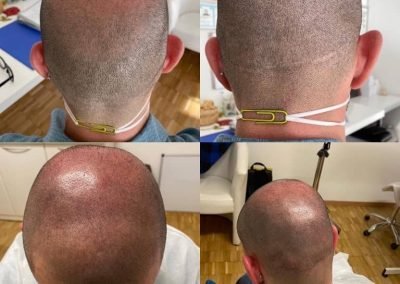 tricopigmentazione copertura cicatrici e infoltimento-min