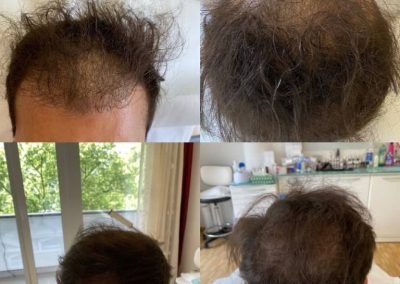 tricopigmentazione copertura-min