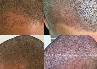 tricopigmentazione copertura tempie uomo-min