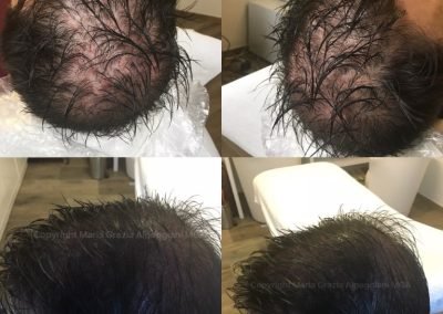 tricopigmentazione densità e tempie-min