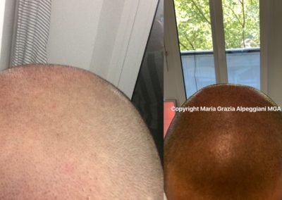 tricopigmentazione densità-min