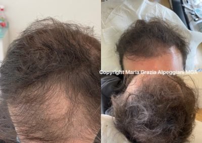 tricopigmentazione densità uomo-min