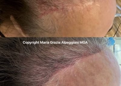 tricopigmentazione donna copertura cicatrici e diradamento-min