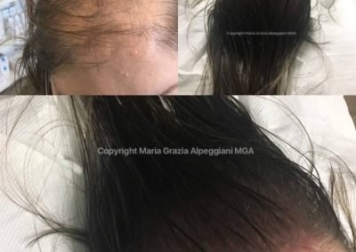 tricopigmentazione donna copertura totale-min