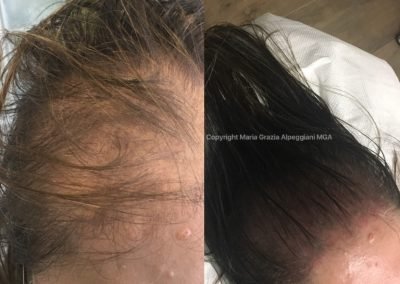 tricopigmentazione donna infoltimento-min