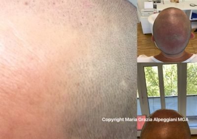 tricopigmentazione effetto rasato-min