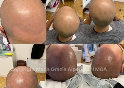 tricopigmentazione effetto rasato totale-min