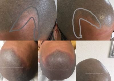 tricopigmentazione infoltimento ed avanzamento tempie-min