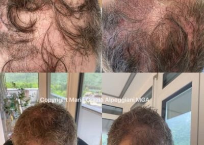 tricopigmentazione infoltimento uomo-min