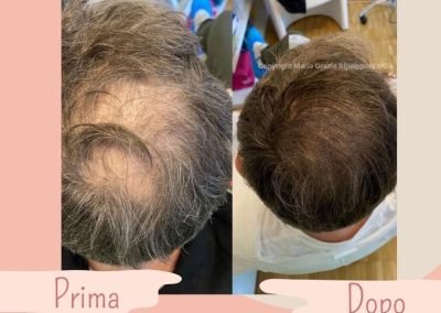 tricopigmentazione l'infoltimento vertex-min