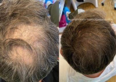 tricopigmentazione naturale-min