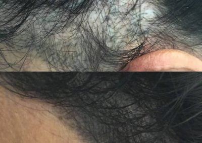 tricopigmentazione naturale tempie-min