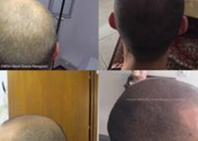 tricopigmentazione prima e dopo infoltimento cuoio capelluto-min