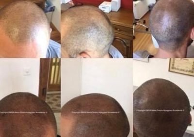 tricopigmentazione soft effetto rasato e riempimento-min