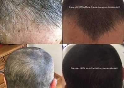 tricopigmentazione uomo prima e dopo-min