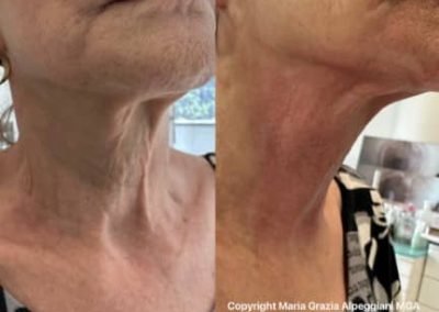 Lifting non chirurgico codice a barre labbra mento sottomento collo