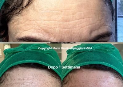 Lifting non chirurgico fronte