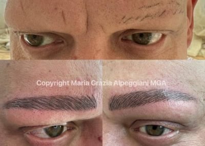 alopecia universale ricostruz totale uomo