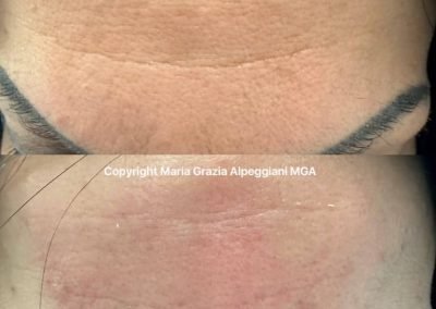 biorivitalizzazione fronte aminoacidi