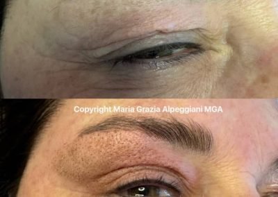 blefaro non chirurgica occhio chiuso 2